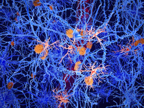 A $6 million grant from the National Institute on Aging will help investigators with UTHealth advance Alzheimer's disease research. (Photo by Getty Images)