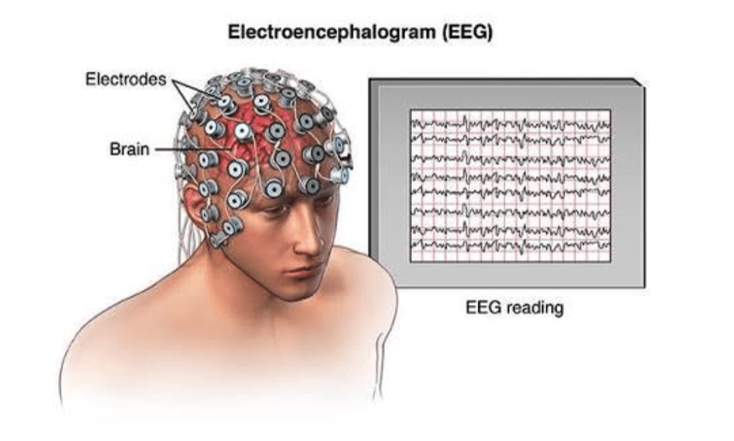 Electroencephalography Eeg Data Showing Onset Of An